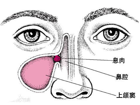 鼻窦炎的最好治疗方法