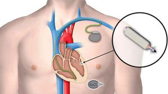 心脏起搏器安装前需注意事项与术后短期的注意事项