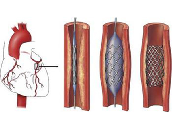 冠状动脉支架价格知多少
