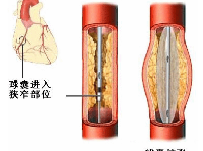 冠脉介入手术过程简单示意图