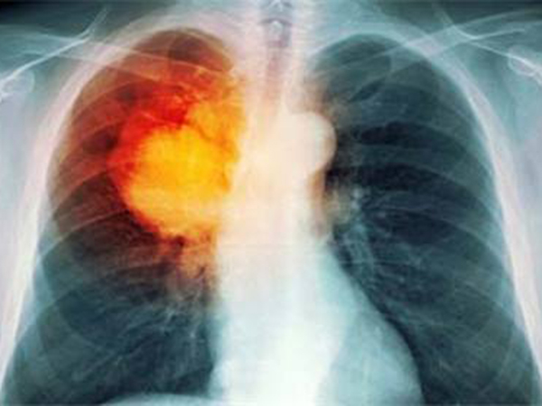 胸腔积液的原因及胸腔积液的症状