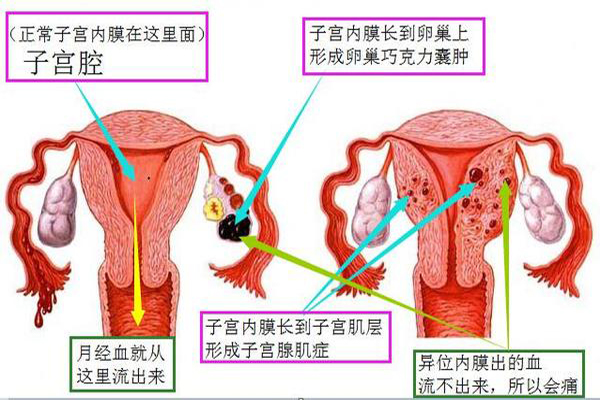 子宫内膜异位症常见症状与病因早知道