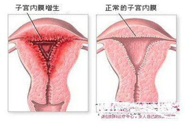 子宫内膜增厚：子宫内膜正常厚度是多少