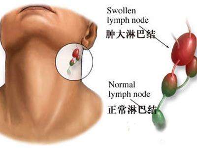 颈部淋巴结治疗 这些方法治颈部淋巴结肿大