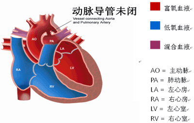 动脉导管未闭-小儿心脏病常见类型之一