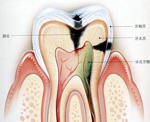 痛彻心扉的“牙髓炎”有什么症状