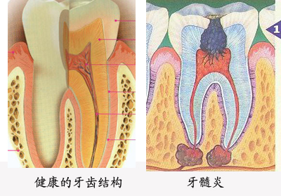 牙髓炎的引发因素有哪些?  