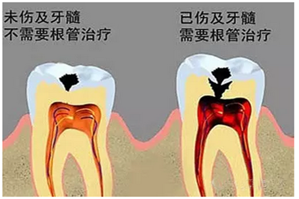 牙髓炎的治疗方法有哪些