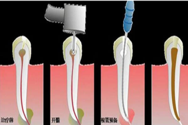 牙髓炎的治疗方法有哪些