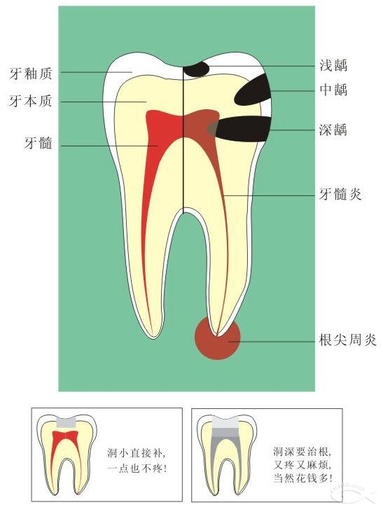 教你秒懂什么是根尖周炎