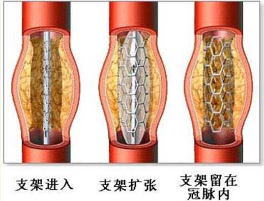 关于冠心病的治疗方法