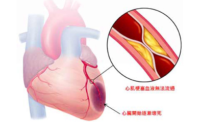 心梗的致命并发症