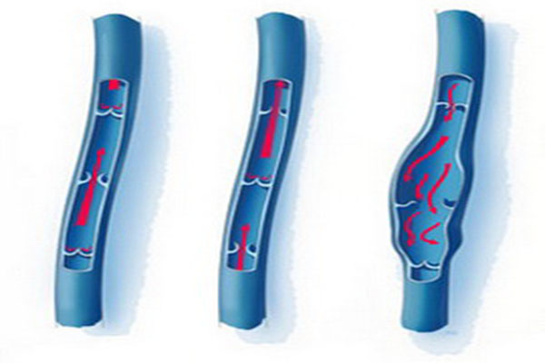 静脉炎的症状是怎样的