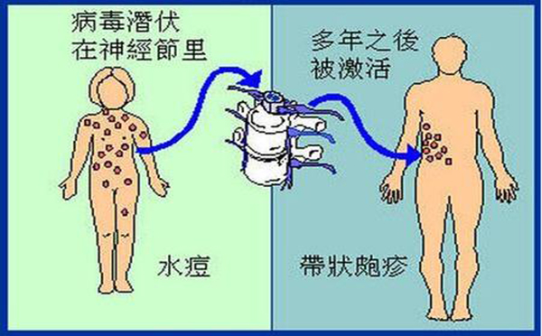 带状疱疹的早期症状不同体现是什么？