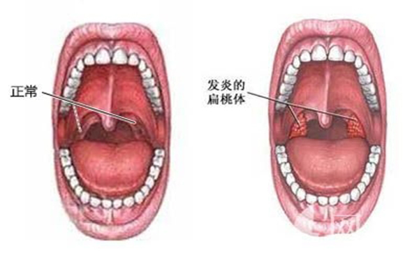 得了慢性扁桃体炎该怎么办啊？