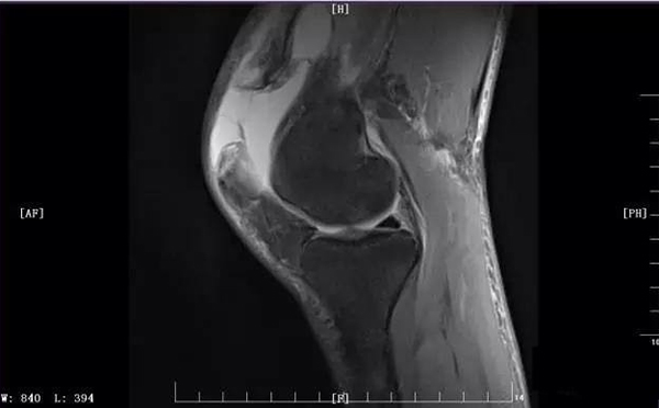 髌骨肌腱断裂医学影像片