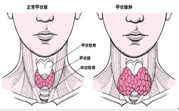 甲状腺囊肿治疗好了以后会不会复发呢