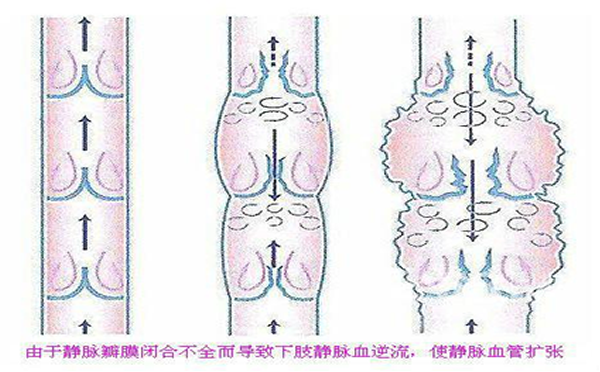 静脉炎患者的常见症状表现