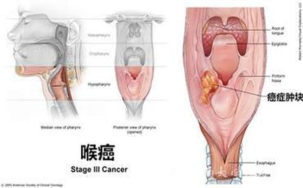 专家解说，喉癌是由什么引起的