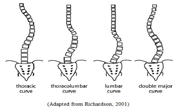 专家向您解答  脊柱侧弯会引起哪些并发症