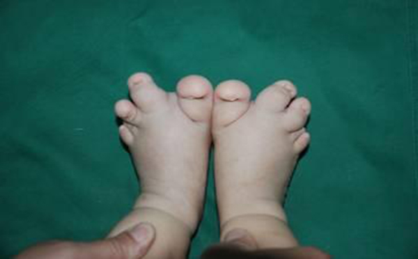 先天性足畸形有哪些表现及如何诊断