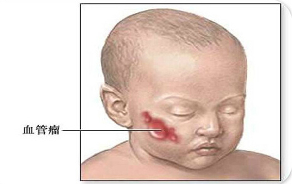 血管瘤有哪些临床症状