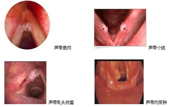 声带息肉的症状有哪些