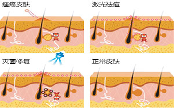 治疗痤疮的几种有效方式