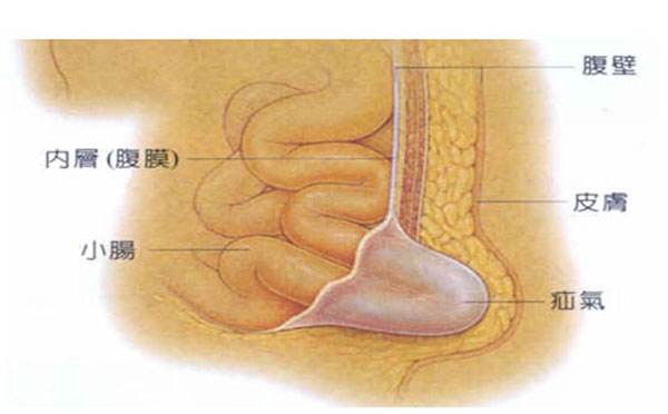 小儿疝气该如何预防