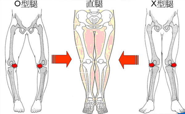 O型腿的形成原因