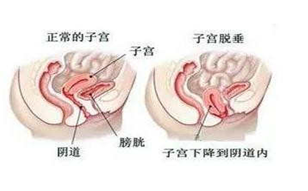 导致子宫脱垂的原因