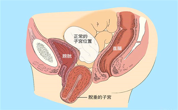 子宫脱垂有哪些危害