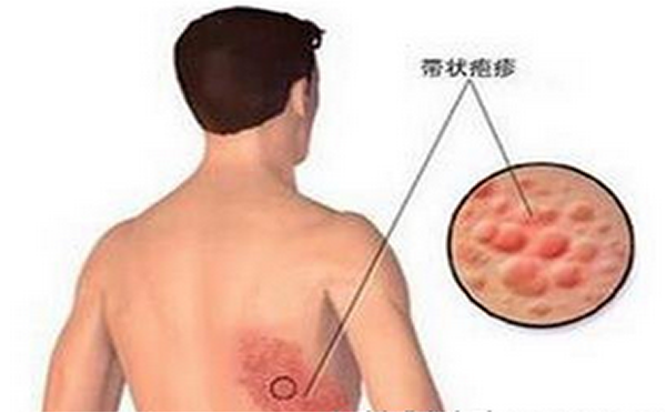 专家解析，带状疱疹是如何引起的