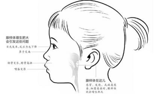 专家向您解答  腺样体肥大是怎么回事