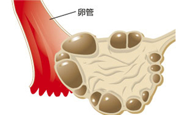 多囊卵巢综合征可能并发哪些疾病