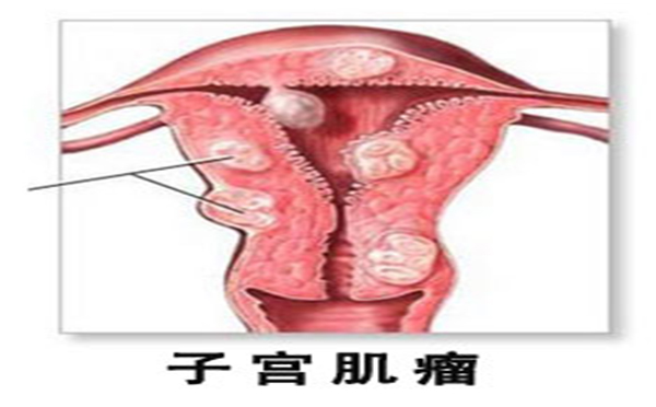 子宫肌瘤是怎么回事