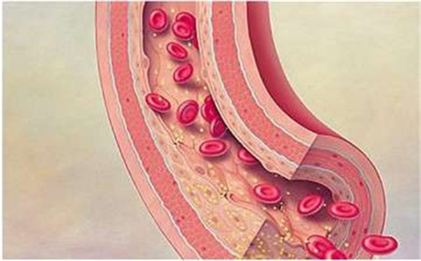 动脉硬化严重不严重呢