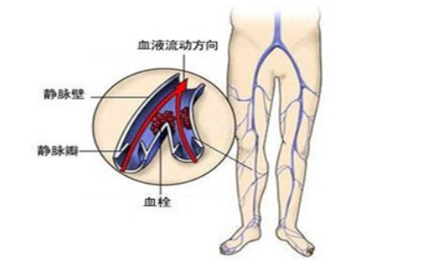 静脉炎是由什么原因引起来的