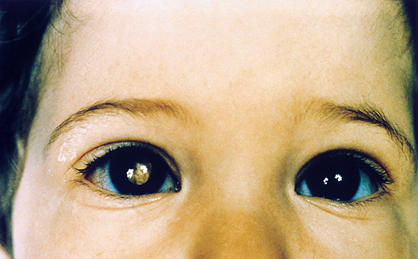视网膜母细胞瘤发病原因