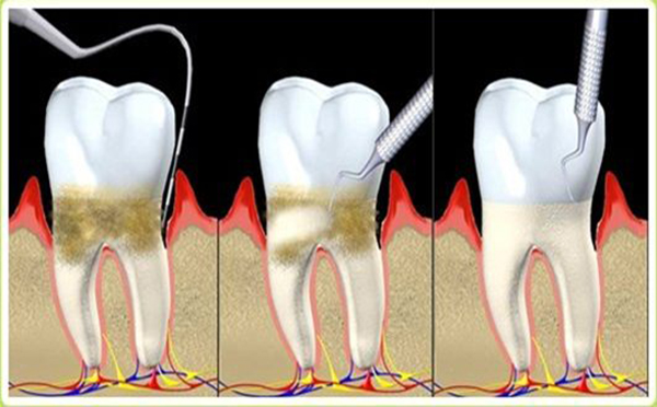 牙周炎易引发的三种严重并发症