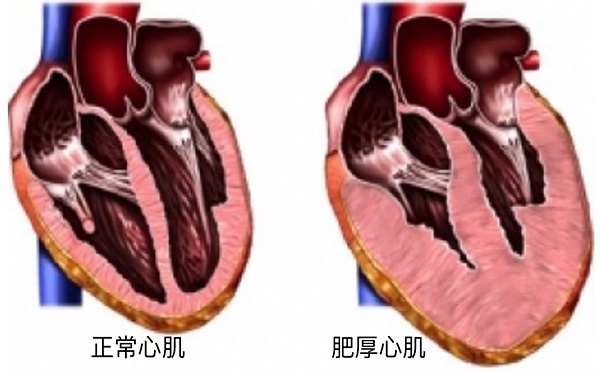 高血压常见的七种并发症