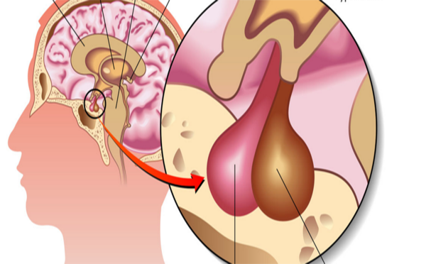 关于垂体瘤有什么不良影响