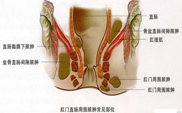 为何男性容易肛周脓肿