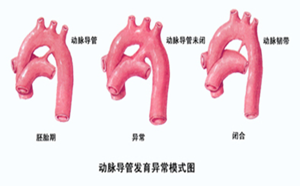 找良医网为您详细解析动脉导管未闭的病因