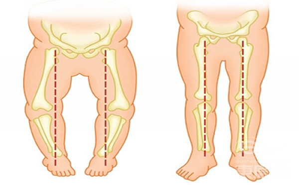 三步矫正O型腿不是梦