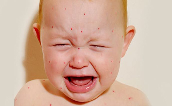 宝宝湿疹要查过敏原吗 解析湿疹的病因