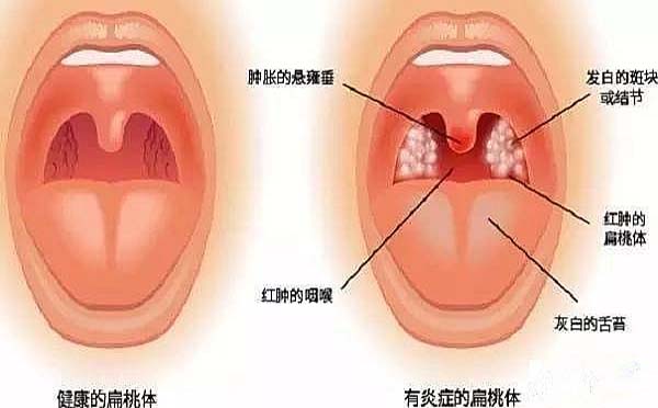 常见扁桃体炎的类型和症状