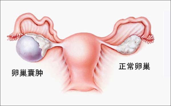 造成输卵管堵塞的原因有哪些