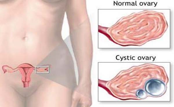 最常见的引起卵巢囊肿的病因