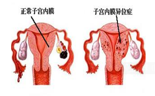 子宫内膜异位 约2亿人都有这个病